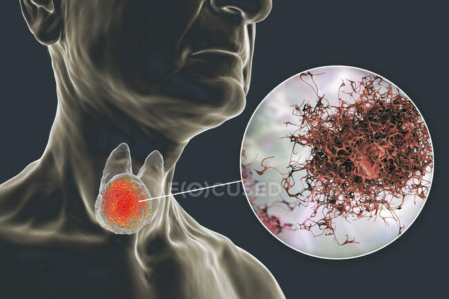 Cáncer de la glándula tiroides con vista de cerca de las células cancerosas, ilustración por computadora. - foto de stock