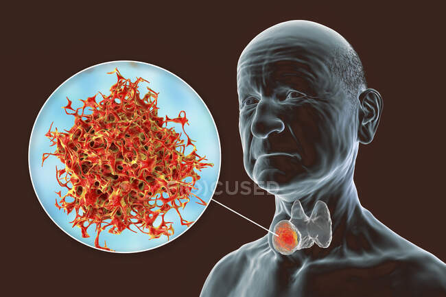Cáncer de la glándula tiroides con vista de cerca de las células cancerosas, ilustración por computadora. - foto de stock