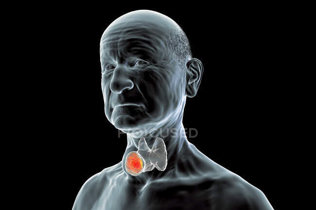Tumor de la glándula tiroides, ilustración por ordenador. - foto de stock