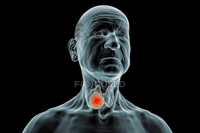 Tumor da glândula tireóide, ilustração computadorizada. — Fotografia de Stock