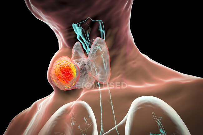 Пухлина щитовидної залози, комп'ютерна ілюстрація . — стокове фото