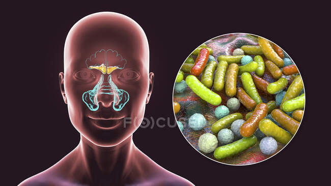 Bacterial sinusitis, computer illustration. The sinuses are membrane-lined air-filled spaces in the bones of the face. The frontal sinuses are above the eyes. Below these are the many lobed ethmoid sinuses and behind them the sphenoid sinuses — Fotografia de Stock