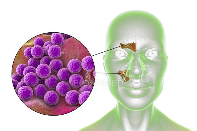 Sinusitis bacteriana, ilustración por computadora. Los senos paranasales son espacios llenos de aire revestidos de membrana en los huesos de la cara. Los senos frontales están por encima de los ojos. Debajo de éstos están los muchos senos etmoides lobulados y detrás de ellos los senos esfenoides - foto de stock