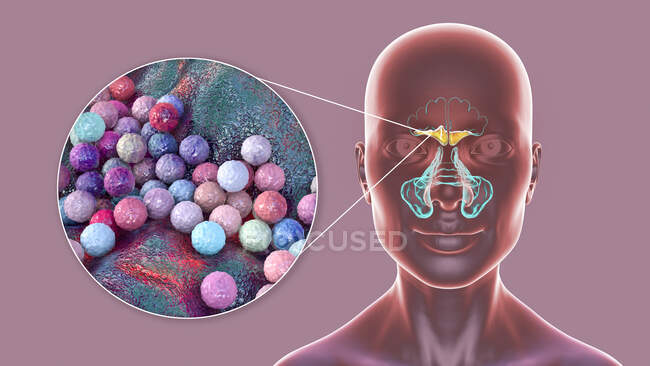 Sinusitis bacteriana, ilustración por computadora. Los senos paranasales son espacios llenos de aire revestidos de membrana en los huesos de la cara. Los senos frontales están por encima de los ojos. Debajo de éstos están los muchos senos etmoides lobulados y detrás de ellos los senos esfenoides - foto de stock