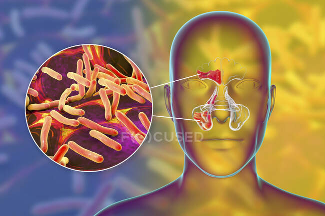 Бактериальный синусит, компьютерная иллюстрация. Пазухи мембранные заполненные воздухом пространства в костях лица. Лобные пазухи над глазами. Ниже приведены многочисленные слоистые носовые пазухи, а за ними клиновидные пазухи. — стоковое фото