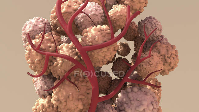 Tumour growth, computer illustration — Stock Photo