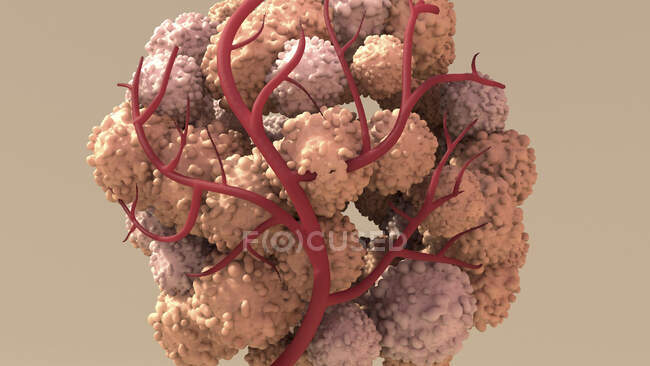 Crescimento tumoral, ilustração computacional — Fotografia de Stock