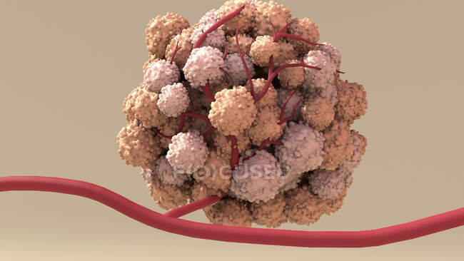 Tumour growth, computer illustration — Stock Photo