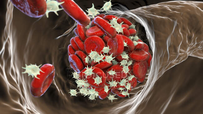 Blood clot, computer illustration — Stock Photo
