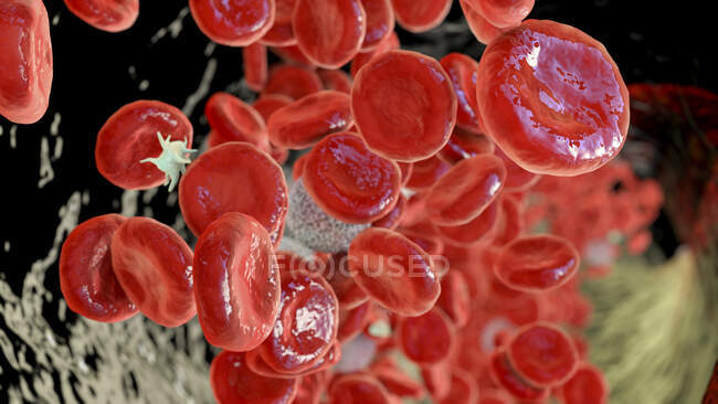 Polycythemia vera, illustration. Polycythemia vera is a rare slow-growing blood cancer in which bone marrow makes too many red blood cells. These excess cells thicken blood, slowing its flow — Stock Photo