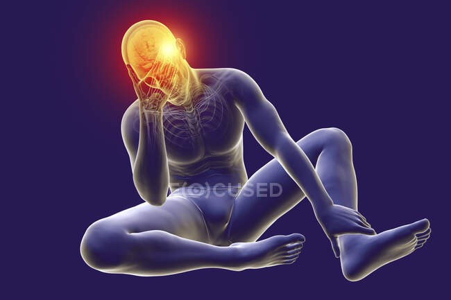 Dor de cabeça, ilustração do computador. Um corpo masculino, com esqueleto, segurando a cabeça com dor. A área vermelha no crânio representa a dor de cabeça — Fotografia de Stock