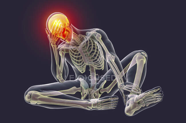 Головний біль, комп'ютерна ілюстрація. Чоловіче тіло, зі скелетом, тримає голову від болю. Червона ділянка черепа символізує біль головного болю — стокове фото