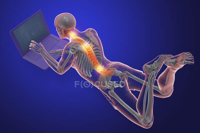 Комп'ютерна ілюстрація, що показує чоловіче тіло з поганою поставою під час роботи на ноутбуці . — стокове фото