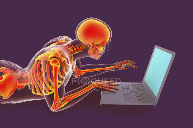 Ilustración de computadora que muestra un cuerpo masculino con mala postura mientras trabaja en una computadora portátil. - foto de stock