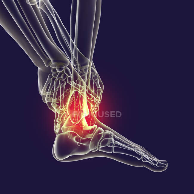 Man with foot pain and highlighted skeleton, computer illustration. — Stock Photo