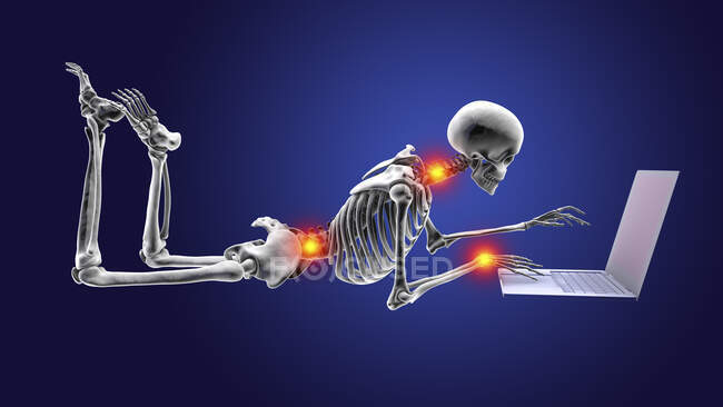 Computerillustration zeigt ein menschliches Skelett mit schlechter Haltung während der Arbeit an einem Laptop. — Stockfoto