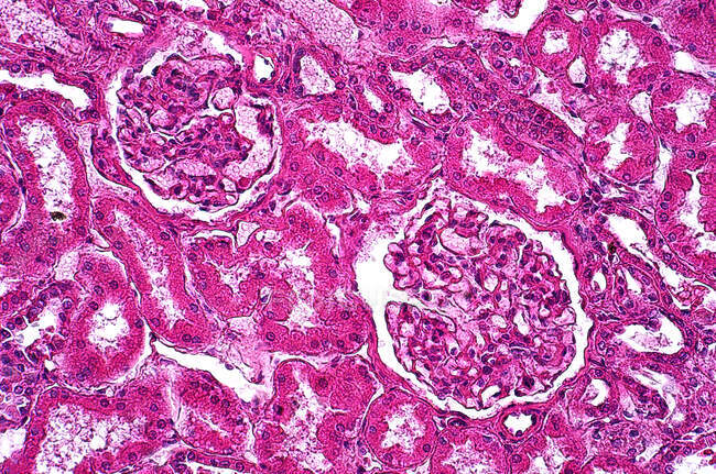 Micrografía ligera de una sección a través del hígado de un paciente con glucogenosis o enfermedad de almacenamiento de glucógeno (GSD). El GSD es una afección rara que cambia la forma en que el cuerpo usa y almacena el glucógeno, una forma de azúcar o glucosa. Hematoxilina y eosina stai - foto de stock