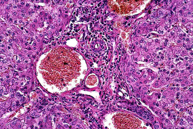 Light micrograph of parenchymatous and fatty degeneration of liver pathology. Haematoxylin and eosin. — Stock Photo