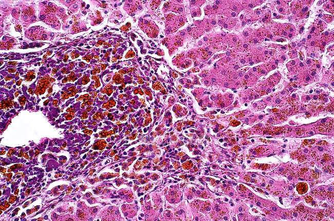Легкий мікрограф, що показує аномальні зміни клітин печінки і тканин. Гематоксилін та еозин.. — стокове фото