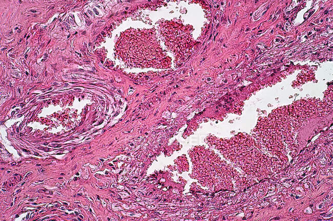 Micrografía ligera de esofagitis necrótica. Tinción de hematoxilina y eosina. - foto de stock