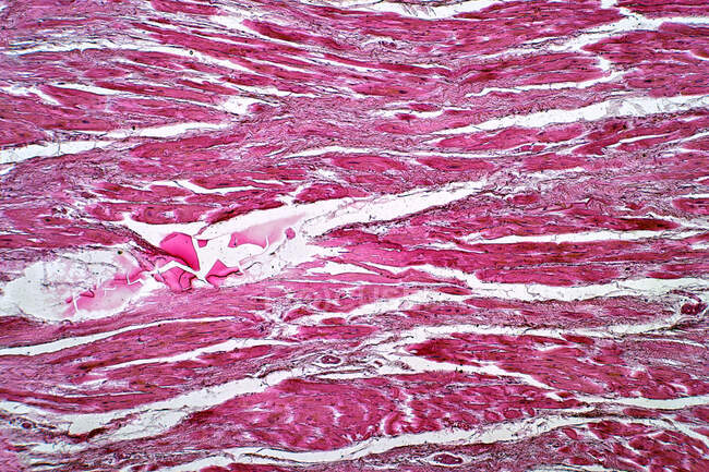 Micrografía ligera de callosidad cardíaca. Tinción de hematoxilina y eosina. - foto de stock