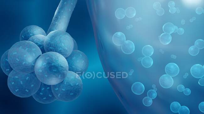 Streptococcus pneumoniae que causa neumonía bacteriana en los alvéolos. - foto de stock