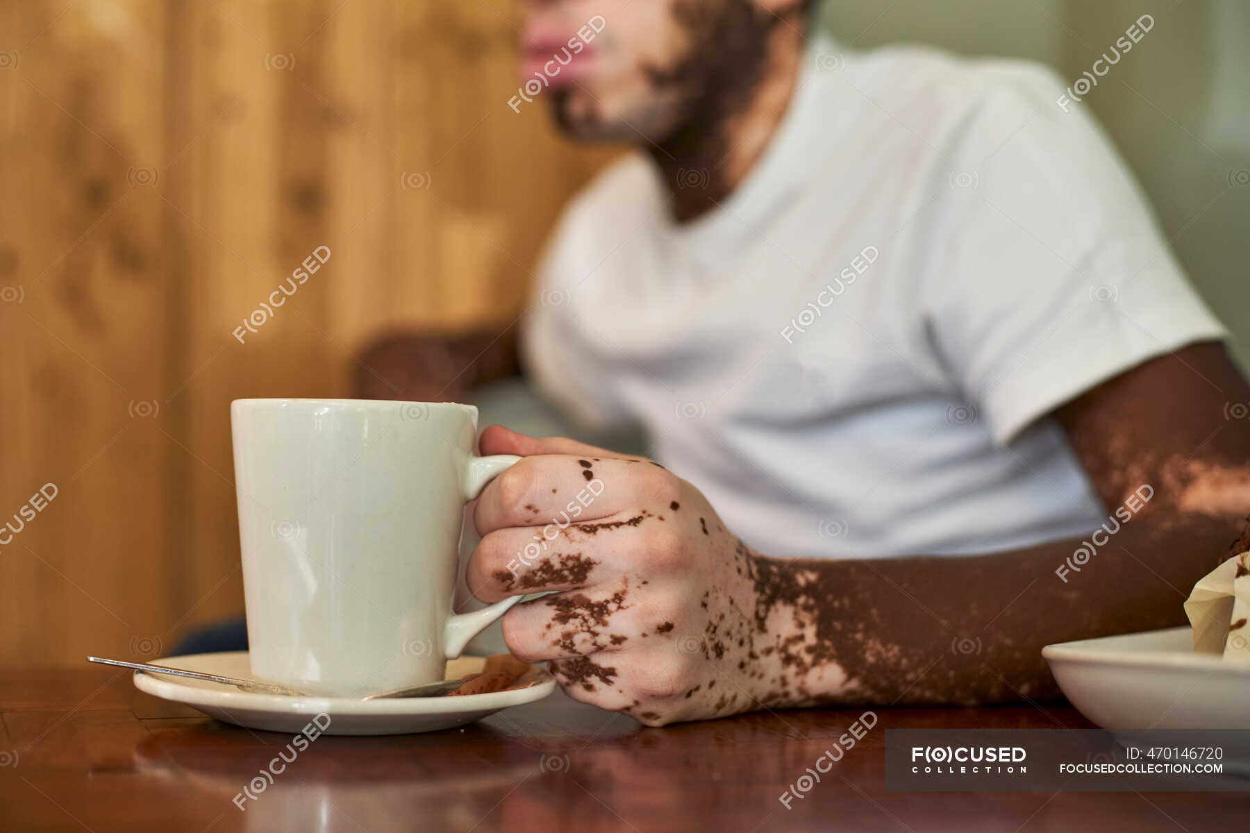 Young man with vitiligo having a cup of coffee in a cafeteria