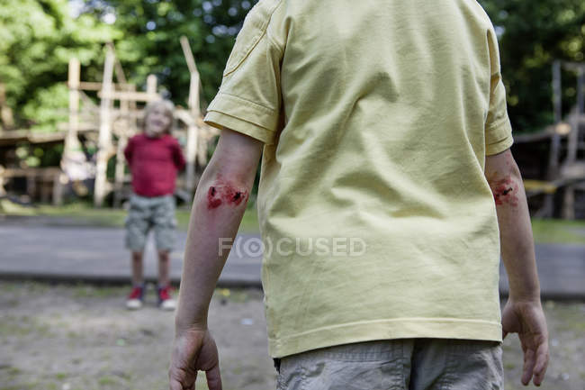 Vista trasera del niño lesionado en el patio jugando con un amigo - foto de stock
