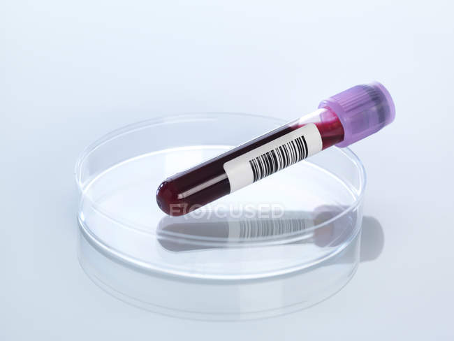 Muestra de sangre en placa de Petri - foto de stock