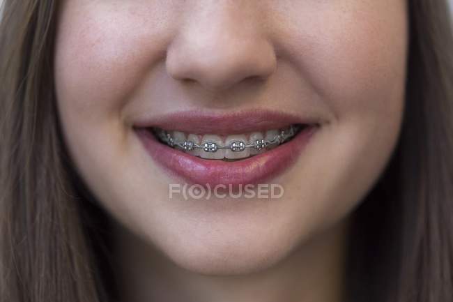 Primo piano di sorridente ragazza adolescente con bretelle — Foto stock