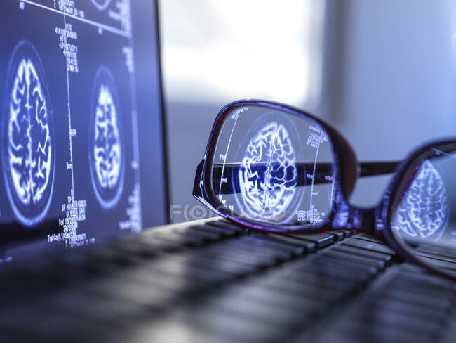 Gehirn-Scan-Ergebnisse spiegeln sich in Schutzbrille auf Laptop-Tastatur — Stockfoto