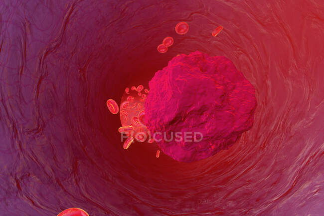 3D rendered Illustration, Mutated leukaemia cell in the lood stream — Stock Photo
