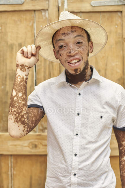 Portrait of young man with vitiligo wearing a hat — Stock Photo