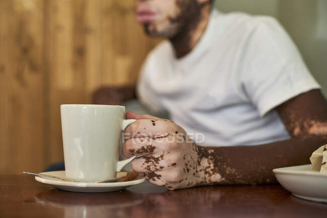 Primer plano de la mano de un hombre con vitiligo sosteniendo una taza de café - foto de stock