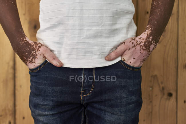 Nahaufnahme des Körpers eines Mannes mit Vitiligo an einer Holzwand — Stockfoto