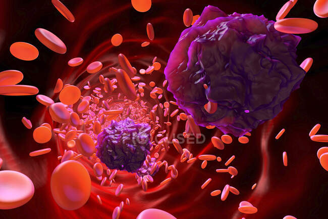 Ilustración 3D de las células leucémicas en el torrente sanguíneo - foto de stock