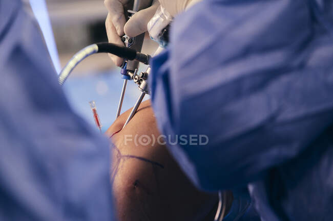 Лікар вставляє ендоскопічне обладнання під час роботи в операційній. — стокове фото