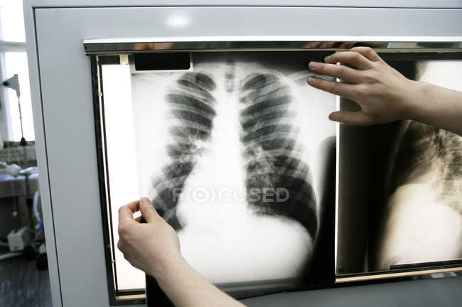 Recadrer les mains masculines en plaçant la radiographie thoracique à boîte à lumière — Photo de stock