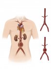 Abdominal aortic aneuryism — Stock Photo