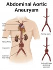 Representación del aneurisma aórtico abdominal - foto de stock