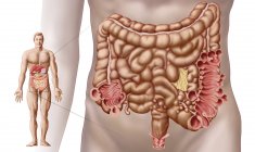 Illustration de diverticulite dans le côlon descendant de l'intestin humain — Photo de stock