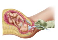 Ilustración médica del parto del feto mediante extracción al vacío - foto de stock