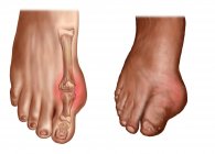 Anatomia dos pés inchados sobre fundo branco — Fotografia de Stock