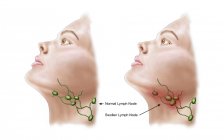 Anatomy of swollen lymph nodes — Stock Photo