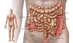 Illustrazione della diverticolite nel colon discendente dell'intestino umano — Foto stock