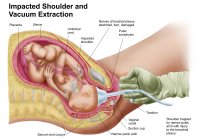 Ilustración médica del parto del feto mediante extracción al vacío - foto de stock