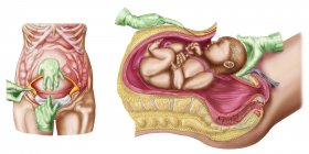 Ilustración médica que muestra el parto por cesárea del feto - foto de stock
