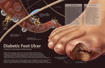 Pathophysiologie diabetischer Fußgeschwüre — Stockfoto