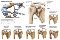 Anatomía de rotura y desplazamiento de la articulación acromioclavicular - foto de stock
