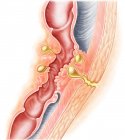 Medical illustration of fistula development — Stock Photo